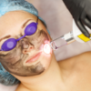 Carbon Laser Facial